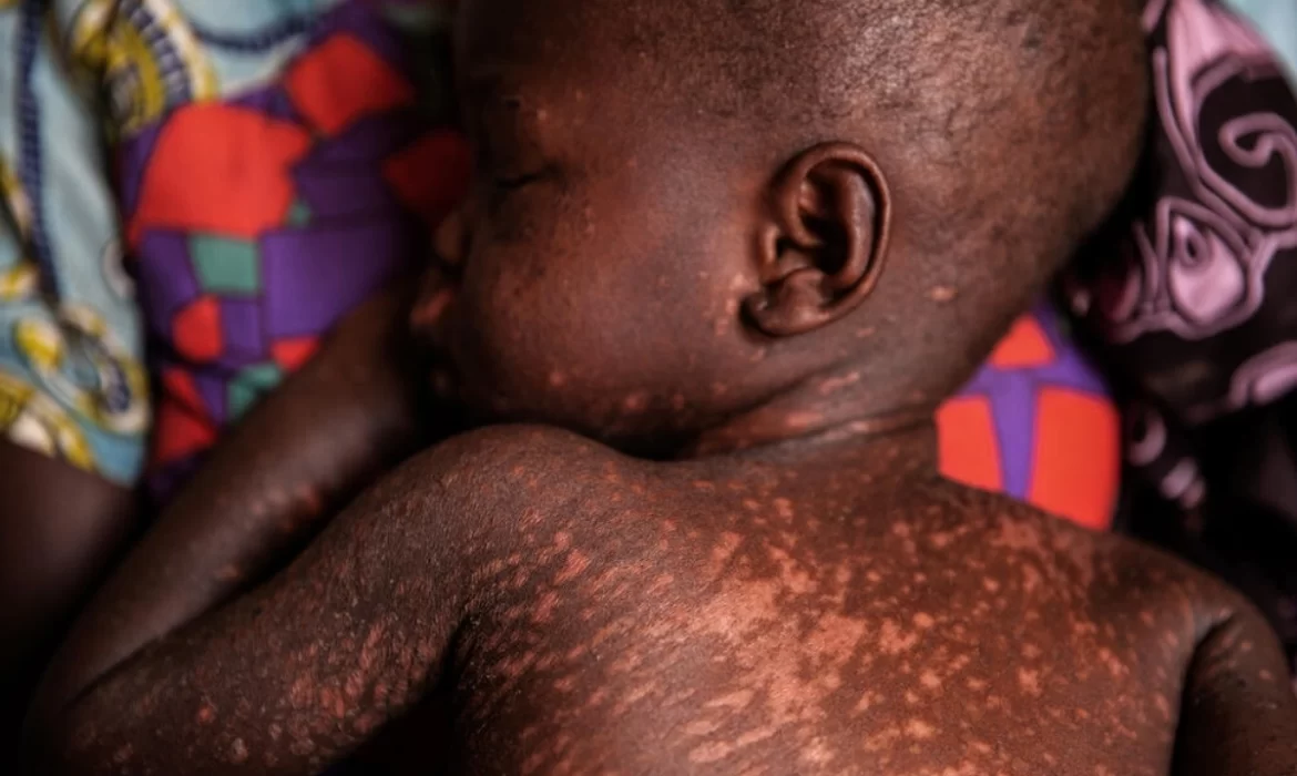 35 Children From An Apostolic Church In Hurungwe Die From Suspected Measles In One Month