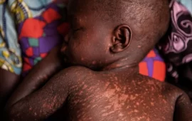 35 Children From An Apostolic Church In Hurungwe Die From Suspected Measles In One Month