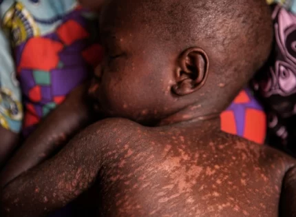 35 Children From An Apostolic Church In Hurungwe Die From Suspected Measles In One Month