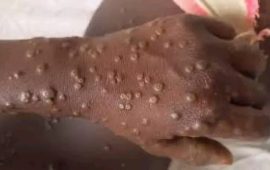 Mpox Outbreak Declared Public Health Emergency in Africa