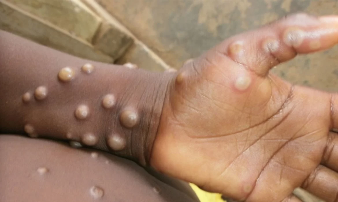 Zimbabwe Government Targets Borders To Combat MPox Public Health Emergency