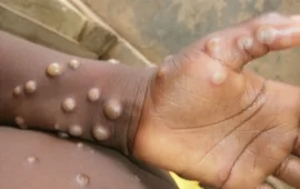 Zimbabwe Government Targets Borders To Combat MPox Public Health Emergency