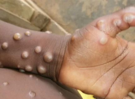 Zimbabwe Government Targets Borders To Combat MPox Public Health Emergency