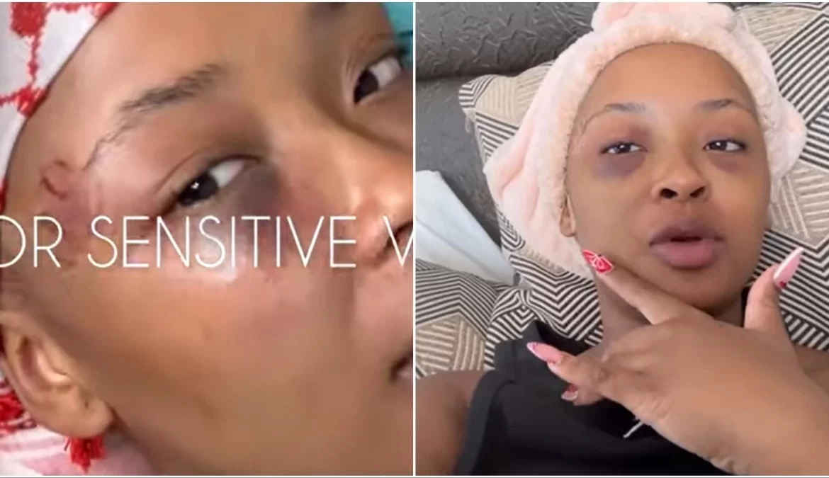 Traumatised Cyan Boujee Shows Swollen Face After Her Ben 10 Beat Her To A Pulp