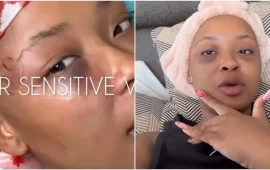 Traumatised Cyan Boujee Shows Swollen Face After Her Ben 10 Beat Her To A Pulp