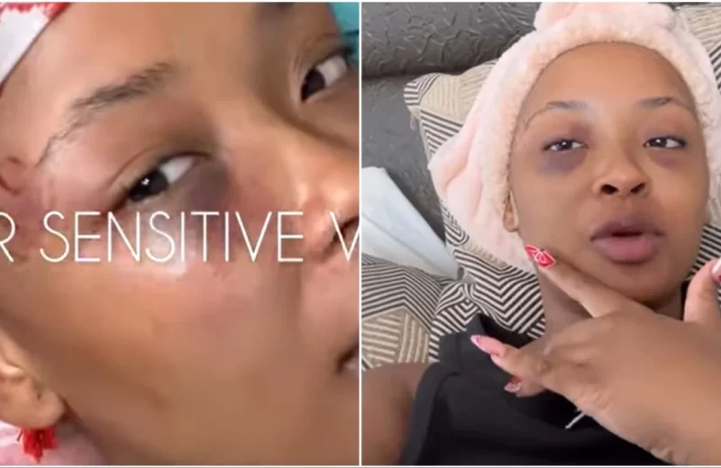 Traumatised Cyan Boujee Shows Swollen Face After Her Ben 10 Beat Her To A Pulp